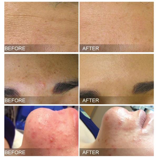 Hydra Peel Dermabrasion Facial Cleaning Beauty Machine Jet Peel Hydra Machine