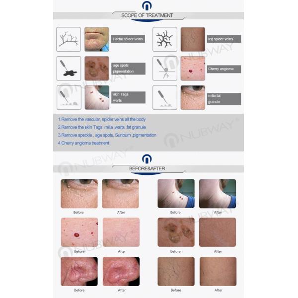 Fastest Result Laser Vascular Vein/Blood Vessels/Spider Vein Removal Machine