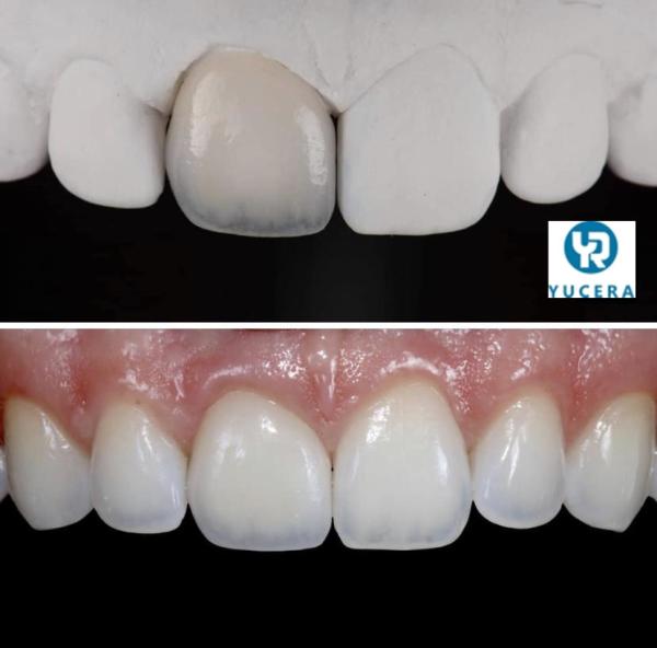 98 95 sistema 3d pro mais a cor dental de Vita 16 dos blocos da zircônia Multilayer
