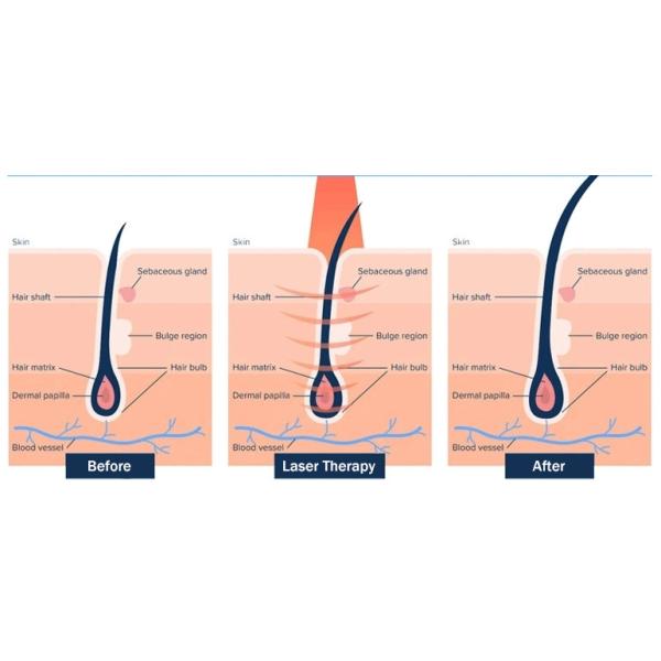 Биологическая машина восстановления волос лазера, машина роста волос обработки скальпа LLLT
