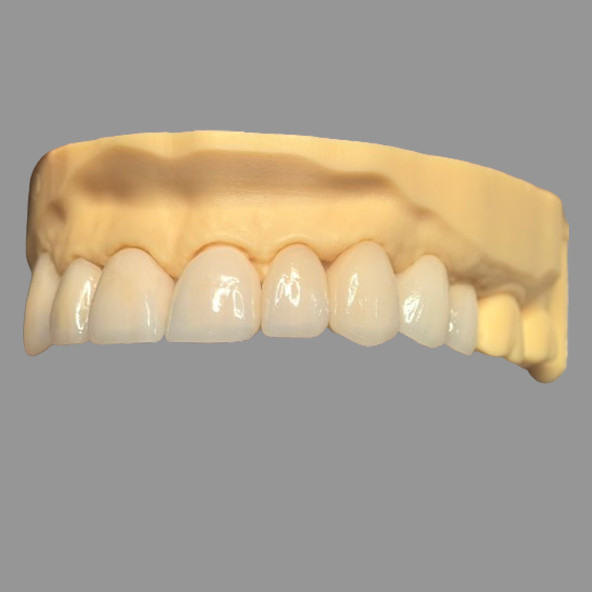 Smooth Pressed IPS EMax Crowns Staining Resistant Customizable