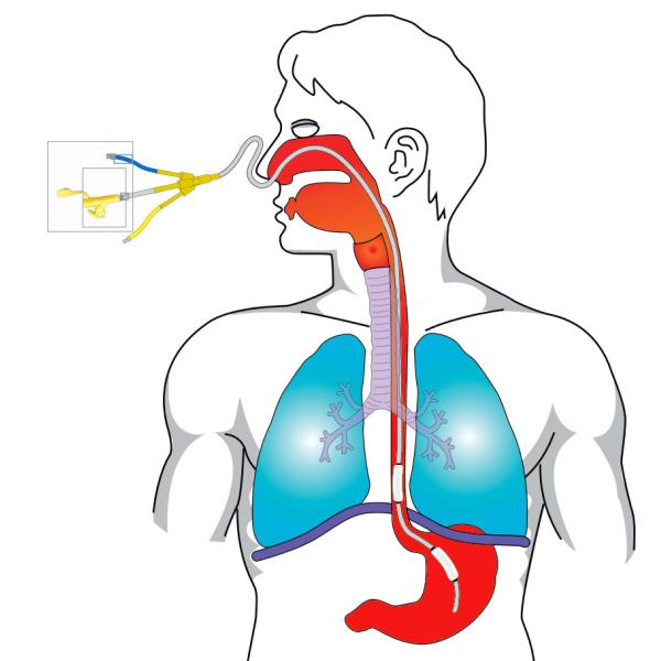 Enteral питательная трубка с одним/2 воздушного шара для Esophageal измерения давления
