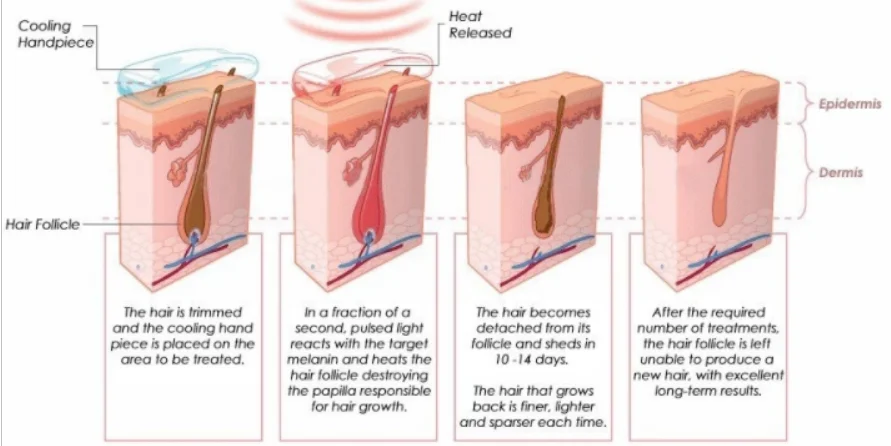 mini 808nm hair removal home use easy to operate, no pain hair removal permanently