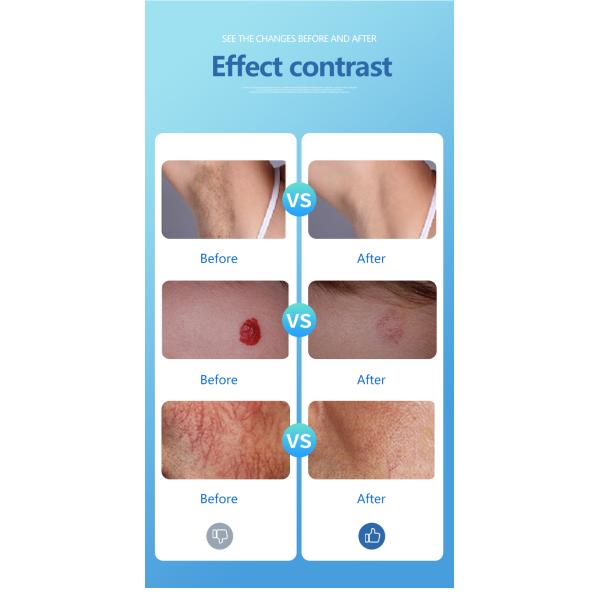 2 dans 1 longue impulsion Q d'Alexander Laser Hair Removal Machine commutez 755 1064 ND Yag