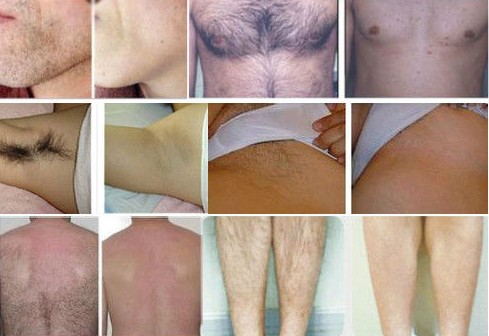 2018 professional 808 nm Diode laser hair removal machine with cooling