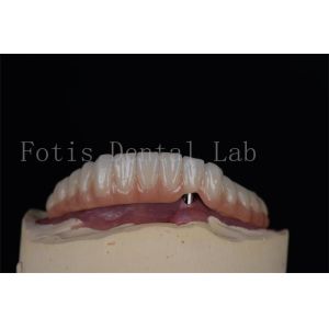 Implantes dentários de titânio ou zircônio de aparência natural Procedimento minimamente invasivo Fácil de limpar