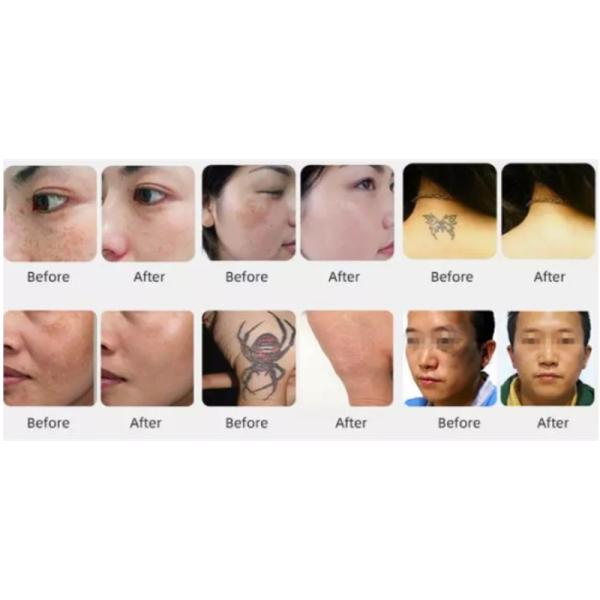 3in1 Ipl 808nm Diode Laser Machine Nd Yag Tattoo Removal Device