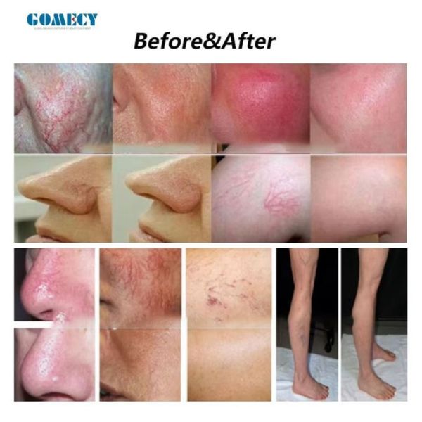 Electrolysis System Permanent Solution Removing  Hair Colors and Vascular Removal Machine