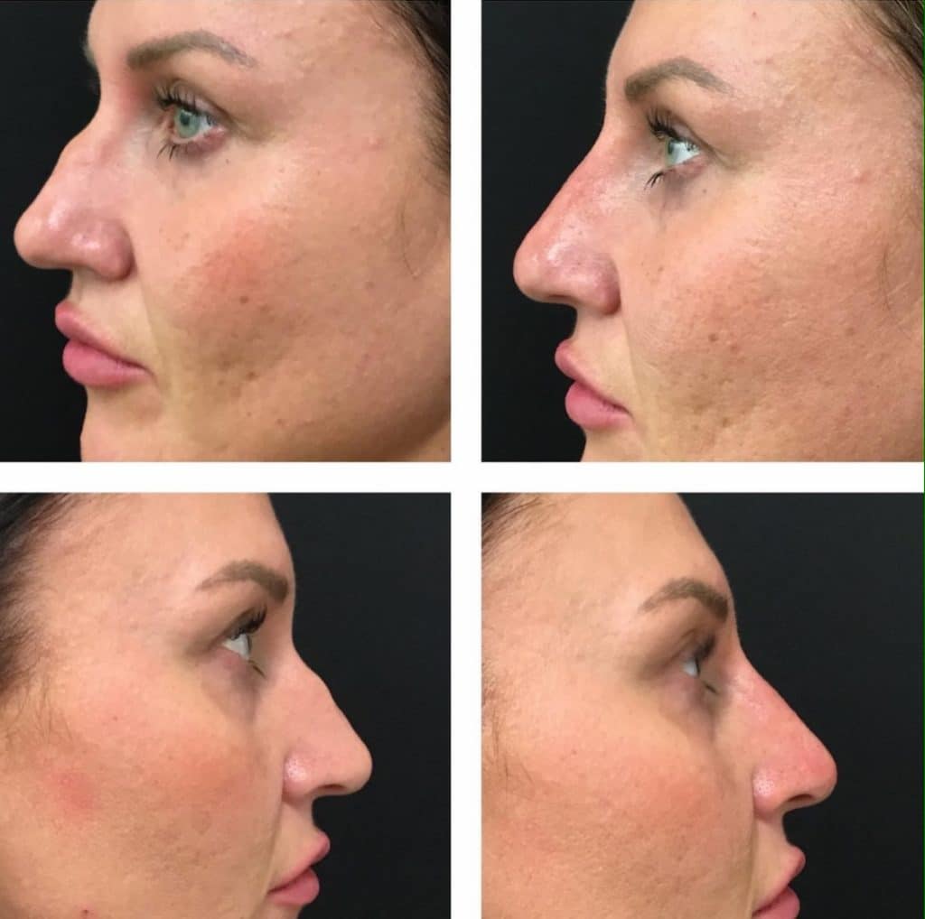Лифтинг лица Удаление морщин Инъекция Juvederm Гиалуроновая кислота Dermal Filler