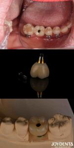 4-6 Dental Endosseous Tapered Implant Subcrestal Bone Level And Internal Hex