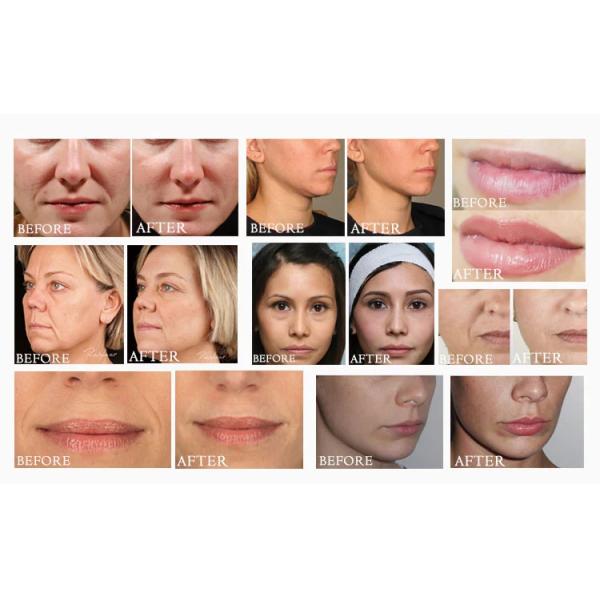 2 мл Juvederm кожный наполнитель для увеличения подбородка гиалуроновая кислота наполнители для носа 24 мг / мл
