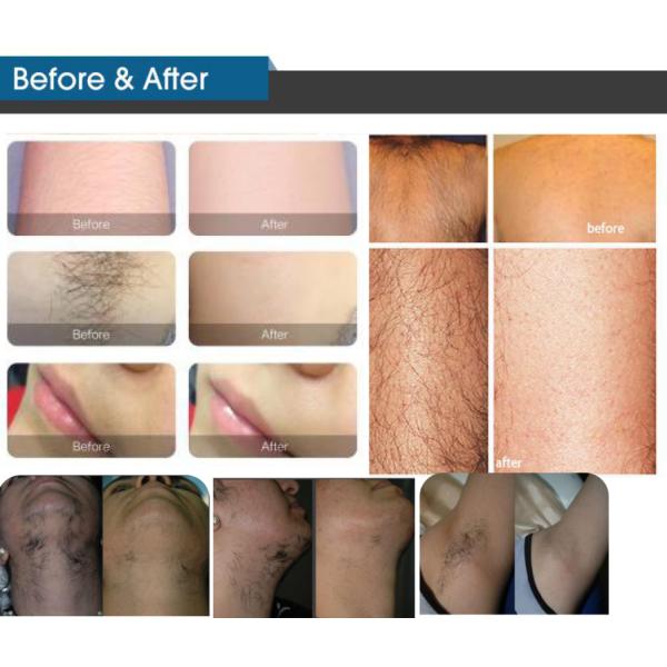 150J 808nm Painless Laser Hair Removal Machine 12mmX12mm Spot