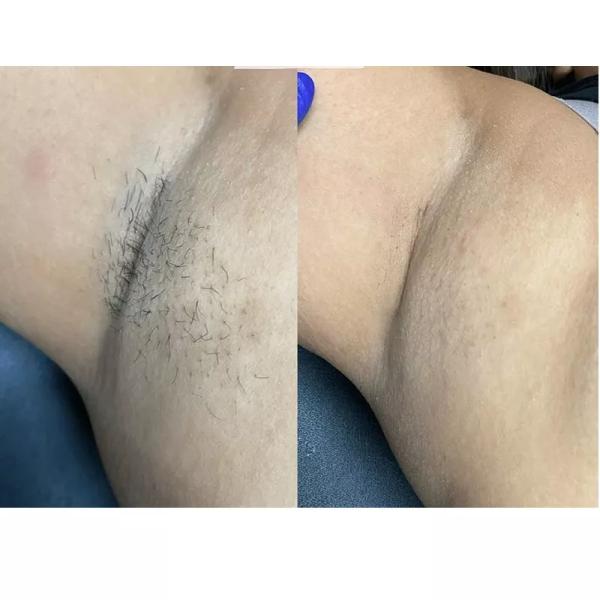 Nd Yag Diode Laser Painless Hair Removal Machine 1064nm 532nm 1320nm 808nm