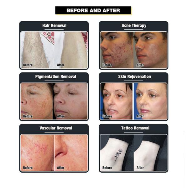 Picosecond Tattoo Diode Laser Hair Removal Machine 808nm Skin Rejuvenation