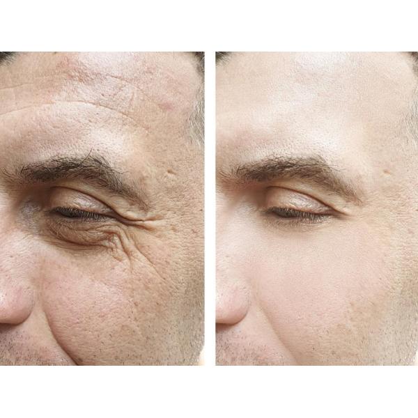 Анти- впрыска дермального заполнителя морщинки 1ml Skinject Hyaluronic кисловочная стерильная