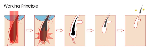 Машина удаления волос лазера диода Painess 3 пар волокна длины волны для салона красоты