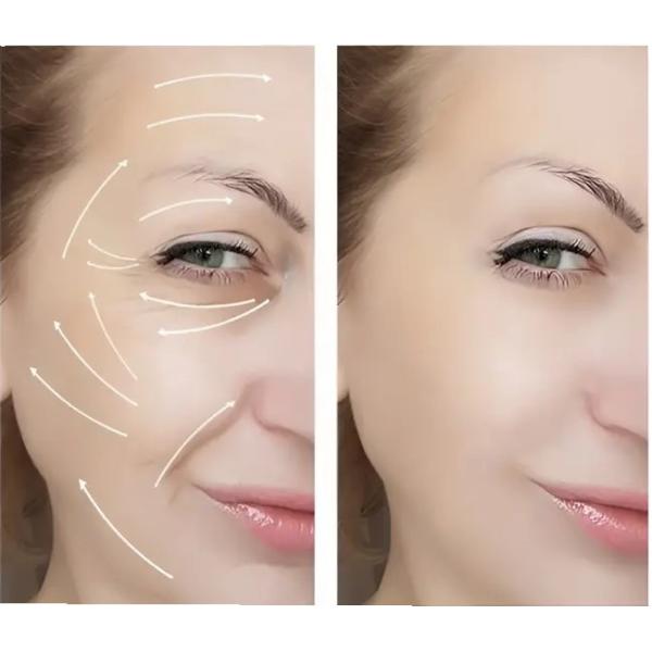Уменьшение морщин Dermal Filler онлайн / В клиниках Быстрое выздоровление Различные глубины лечения