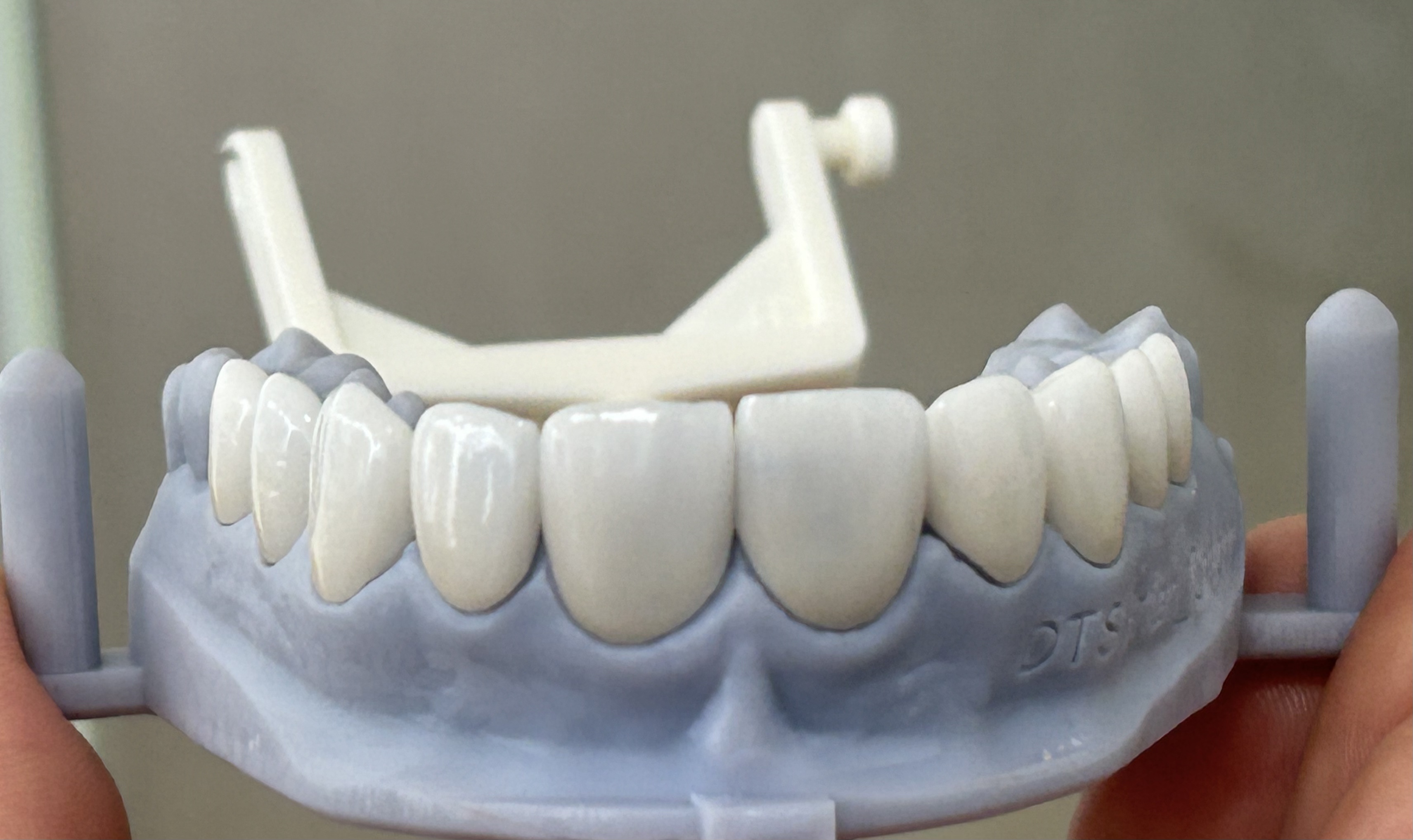 Natural-Looking Esthetics Ceramic Veneers with Customized Tooth Shape and Precise Laboratory Fabrication