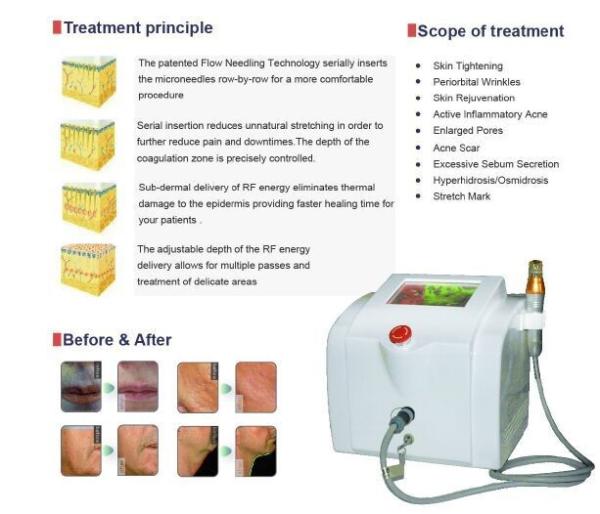 Skin tightening beauty machine fractional rf for face