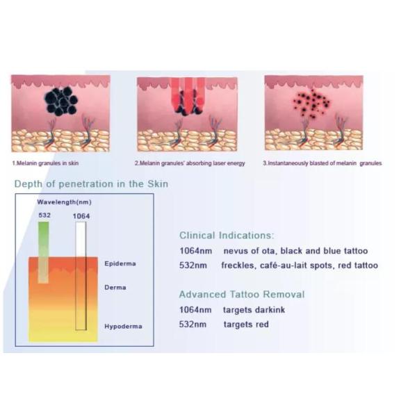 Portable Q Switched Nd Yag Laser Machine For Tattoo / Pigmentation Removal