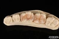 Natural Polymerized Porcelain Dental Inlay Onlay For Tooth Restoration