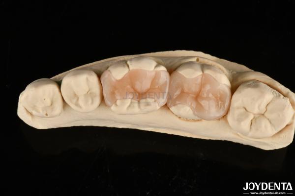 Natural Polymerized Porcelain Dental Inlay Onlay For Tooth Restoration