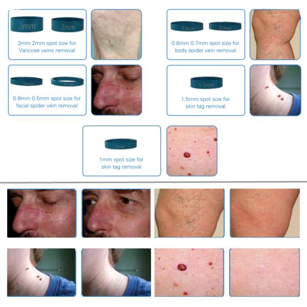 Top quality easy work diode 980nm laser vascular removal machine for sale