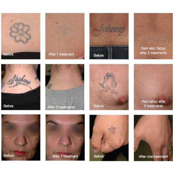 4 In 1 Multifunctional Beauty Machine Triple Wavelength Laser Hair Tattoo Removal Machine