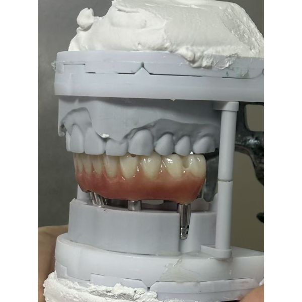 Monolithic Zirconia Implant Bridge for Full Arch Restoration with CAD/CAM Precision