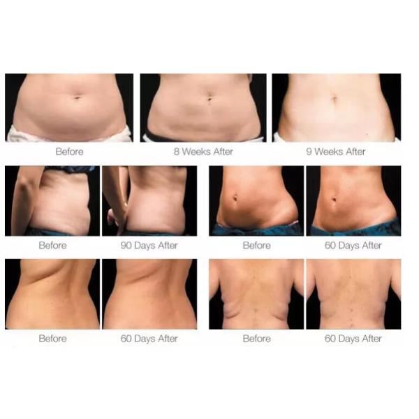 Slim Freeze Fat Freeze Slimming Machine Vacuum Cryolipolysis System Operated