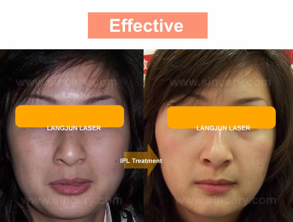 Оборудование удаления волос лазера ИПЛ профессиональное