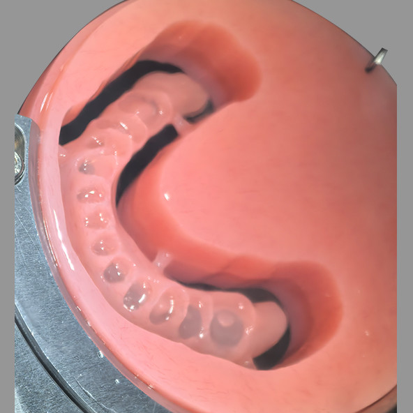 CAD/CAM Digital Milled Acrylic Base Denture Removable