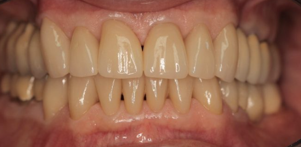 98*20mm A1 Translucent Pre Sintered Zirconia Blocks Yttria Stabilized CAD CAM