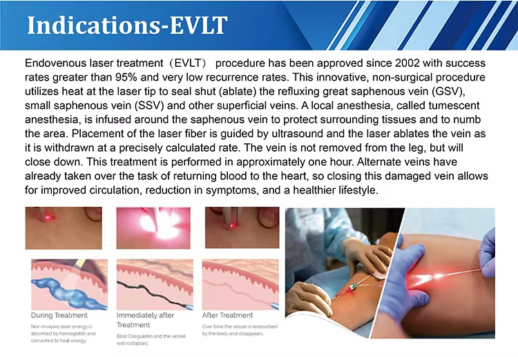 Evlt Phlebology Endovenous Laser 1940nm Fiber Veins Laser Machine