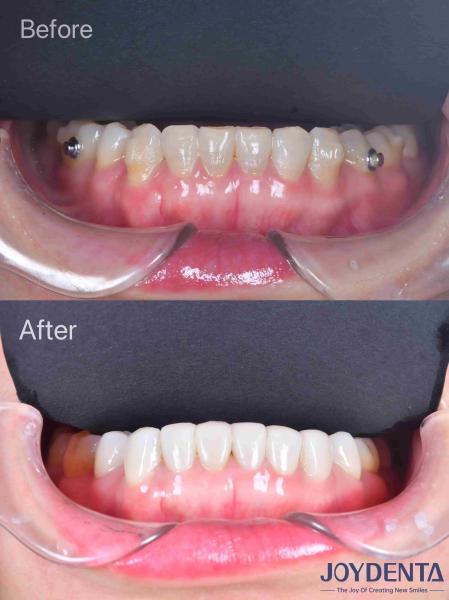 Porcelain Veneer Oral Restoration