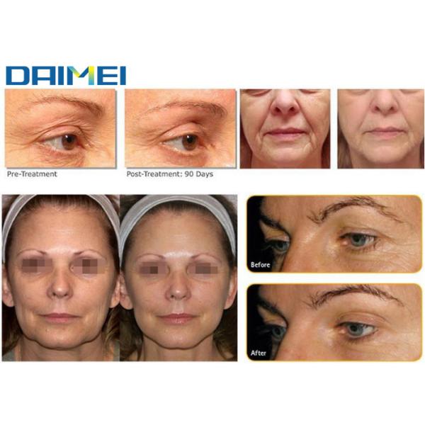 Non Invasive HIFU Beauty Machine 5 10000 Shots Cartridges For Salon / Clinic Spa