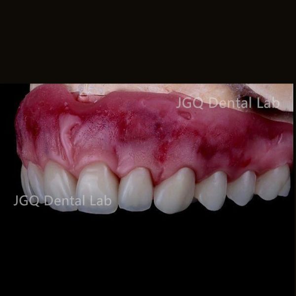 3D Printer Zirconia Crown and Bridge Hybrid Dental Implant with Titanium Abutment