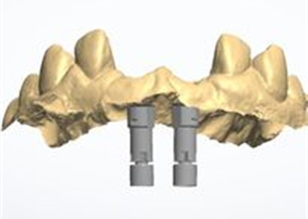 Modelo en 3D Corona de zirconio