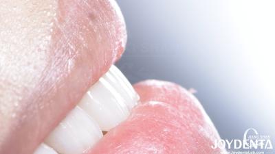 Finition dentaire composite durable Bonne biocompatibilité Pas de goutte de finition de porcelaine