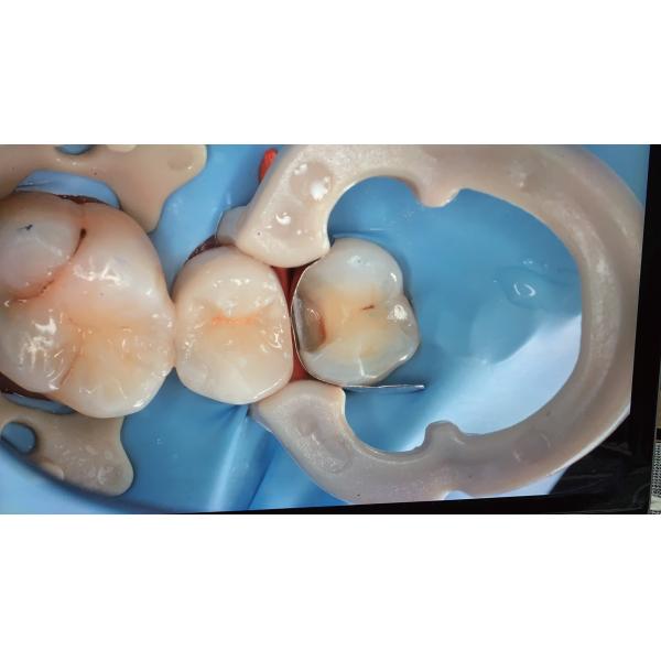 Dentistry Dental Sectional Matrix System Composite Clamp Ring R3