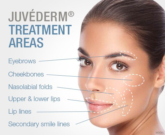 Повышение губы Juvederm 2x1ml заполнителя Ha впрыски извлекает морщинки