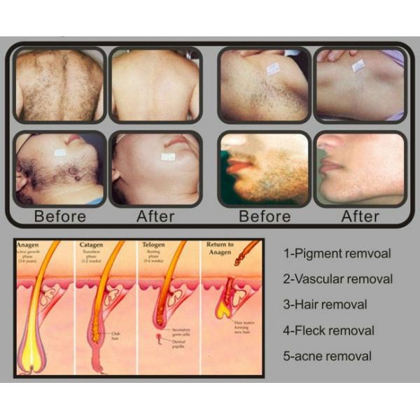 Hair removal in Motion IPL shr Hair Removal Machine Equipment 2 hands for clinic spa