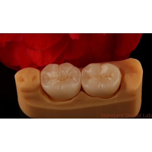 Full Contour Zirconia Crown Exceptional Strength and Esthetics No Porcelian Overlay Posterior Crown China Dental Lab