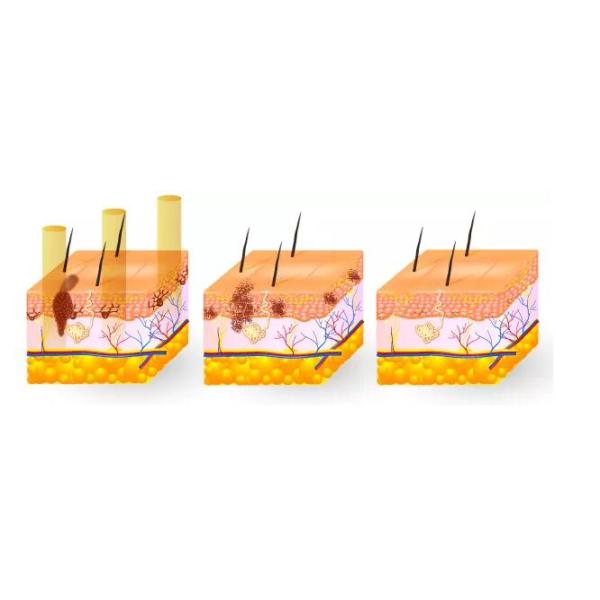 Portable Long Pulse Yag Laser Tattoo Removal Machine Painless For Beauty Salon