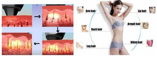 Tri cooling 12 hours constant working Portable diode laser hair removal machine easy work