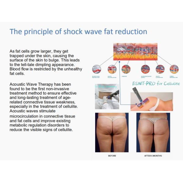 Машина облегчения боли целлюлита Eswt 200mJ Shocewave анти- электромагнитная