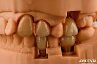 Une couronne et un pont d'implant personnalisables donnent un aspect naturel et des résultats durables