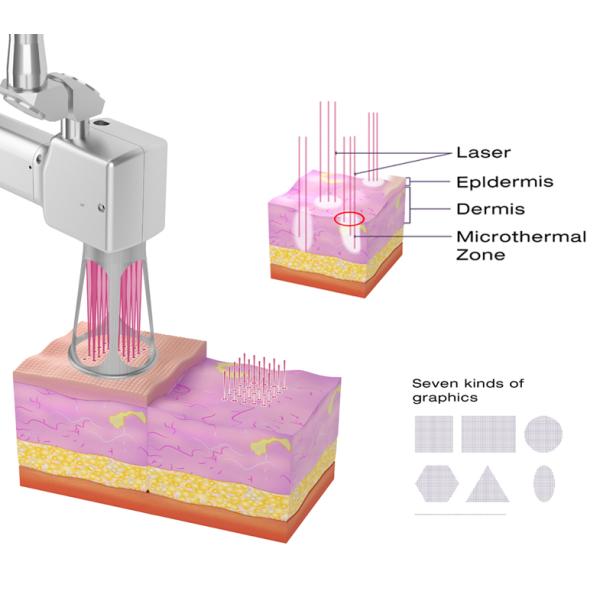 Clinic CO2 Fractional Laser Machine Scar Removal Laser Skin Rejuvenation Machine