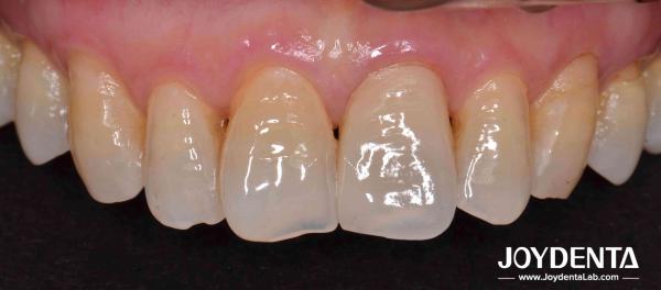 Zirconia dentures that imitate natural teeth