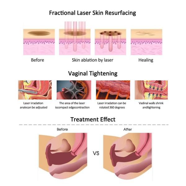 Регулируемая 1-60 Вт лазерная машина для удаления шрамов